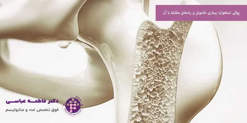 پوکی استخوان؛ بیماری خاموش و راه‌های مقابله با آن