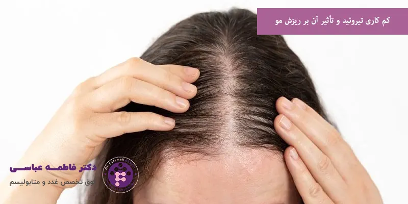 کم کاری تیروئید و تأثیر آن بر ریزش مو